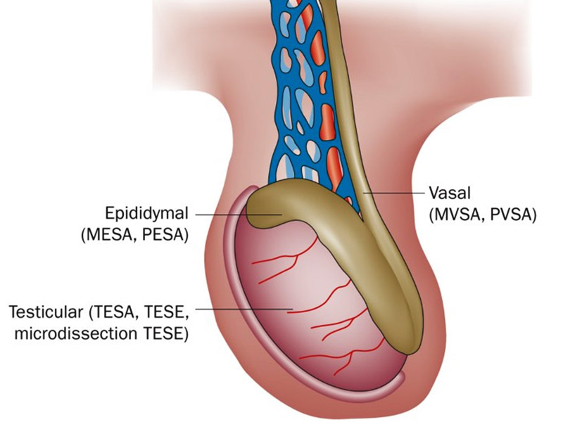 TESE Testicular Sperm Extraction
